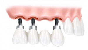 Multiple Dental Implants