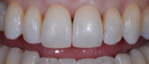 Front View - before black triangles treatment