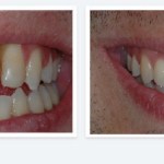 Smile Gallery before and after