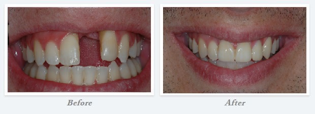 Smile Gallery before and after