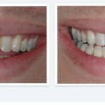 Smile Gallery before and after 2