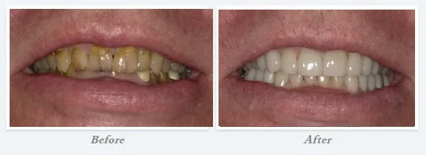 Smile Gallery drastic before and after