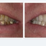 Smile Gallery drastic before and after